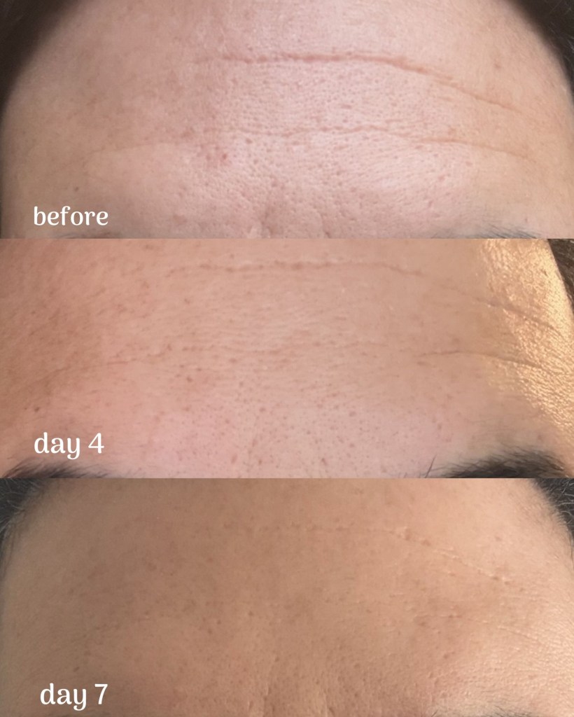 Before and After Photos of Botox Filler