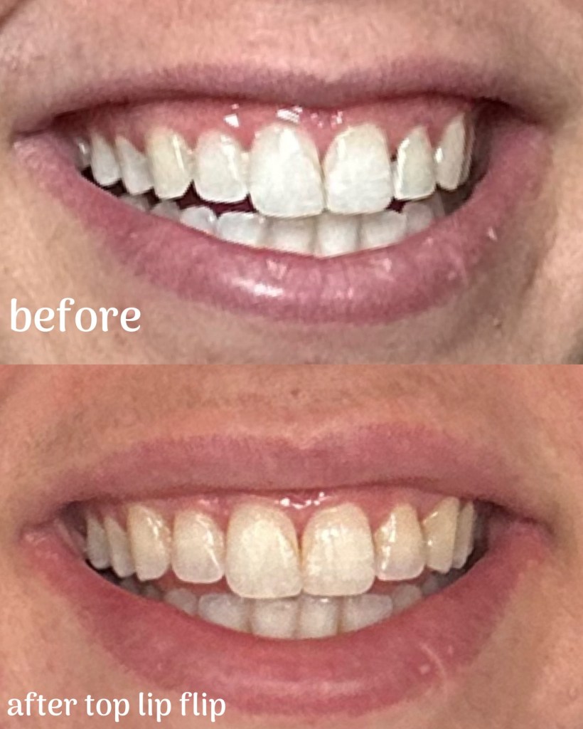 Before and After photos of top lip flop procedure
