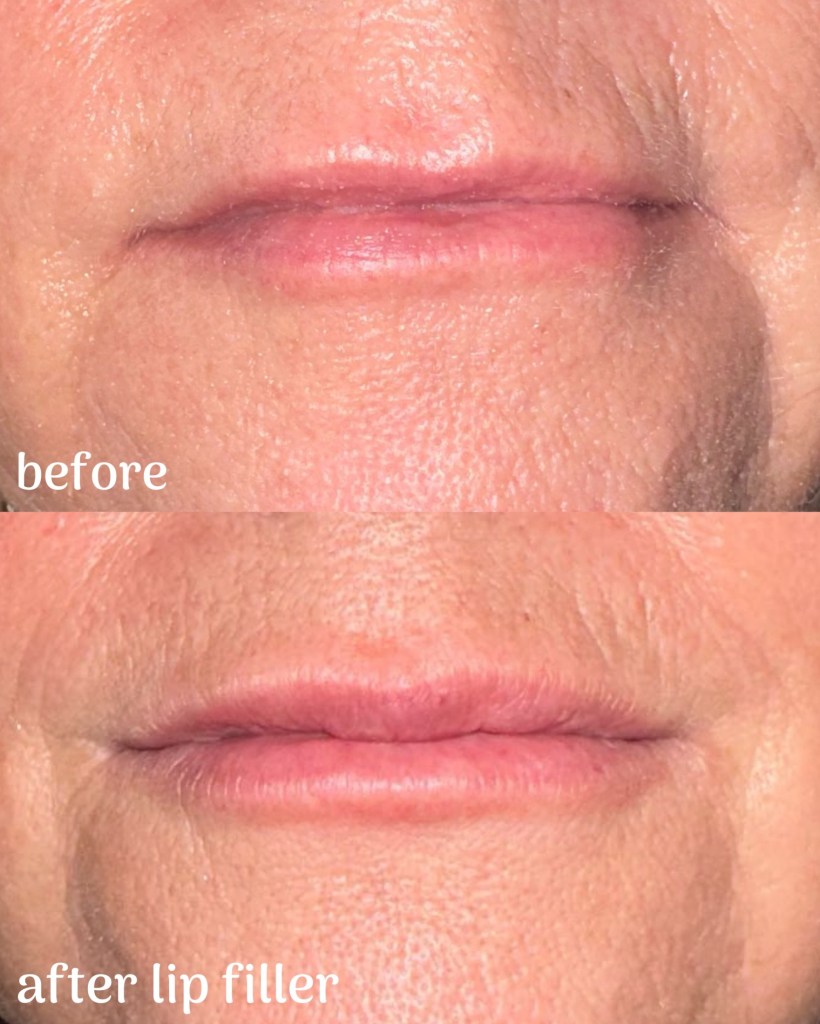 Before and After Photos of Botox Lip Filler